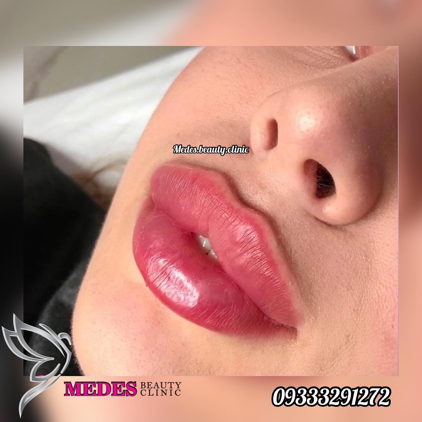 گالری تزریق ژل لب